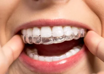 5 Things to Consider Before Getting Invisalign