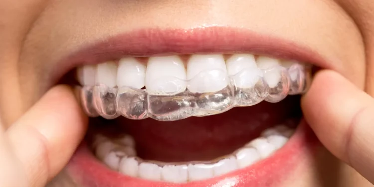 5 Things to Consider Before Getting Invisalign