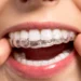 5 Things to Consider Before Getting Invisalign